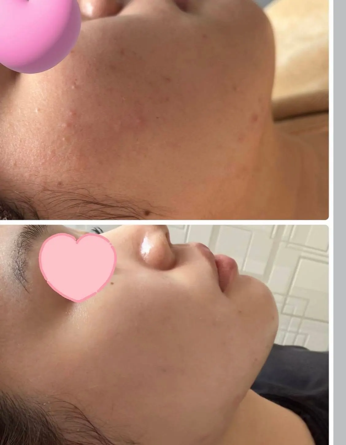 頬の肌表面を上下に並べた施術前後の写真